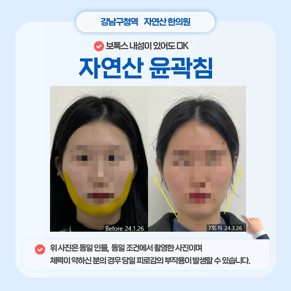 윤곽 관리 전후사진 2