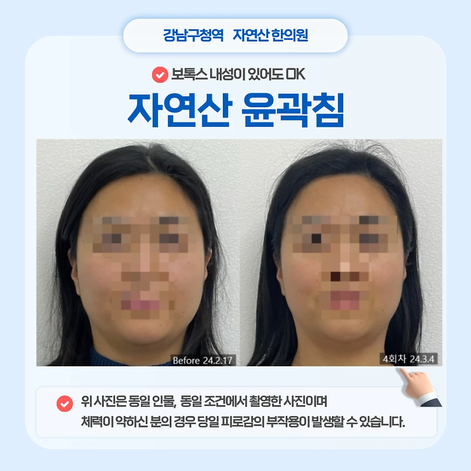 윤곽 관리 전후사진 3