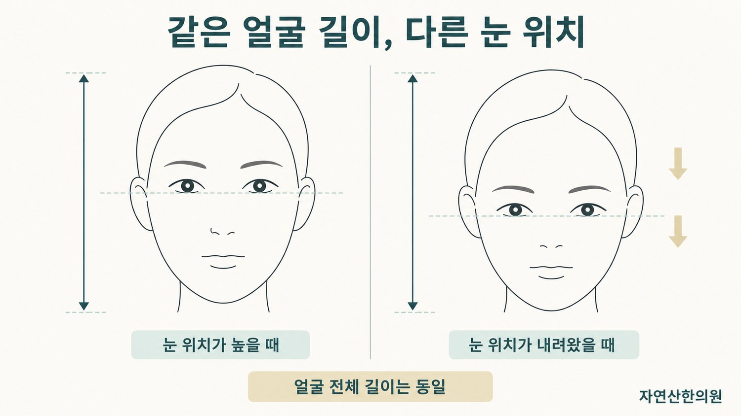 얼굴 전체 길이는 같고 눈 위치만 다른 두 얼굴을 나란히 놓아 짧아 보이는 효과를 비교한 도해