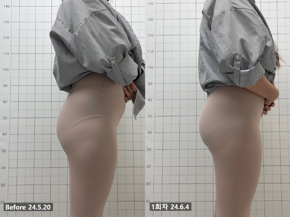 애플힙 시술 기록 3 — 동일 인물·동일 조건에서 촬영한 보정 없는 원본 사진