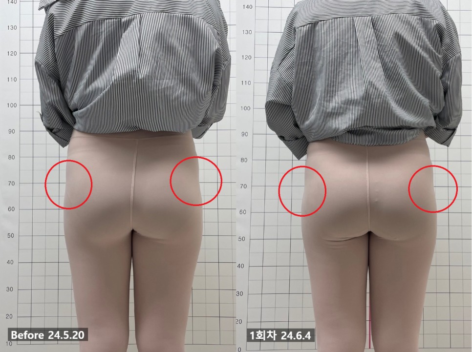 애플힙 시술 기록 4 — 동일 인물·동일 조건에서 촬영한 보정 없는 원본 사진