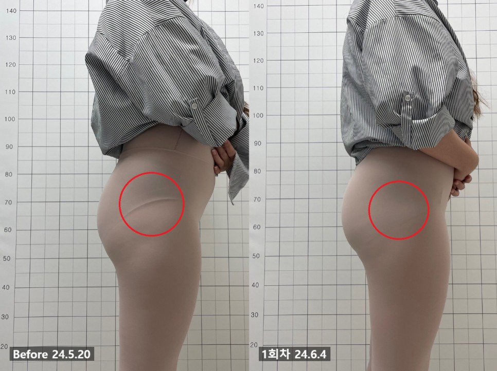 애플힙 시술 기록 5 — 동일 인물·동일 조건에서 촬영한 보정 없는 원본 사진