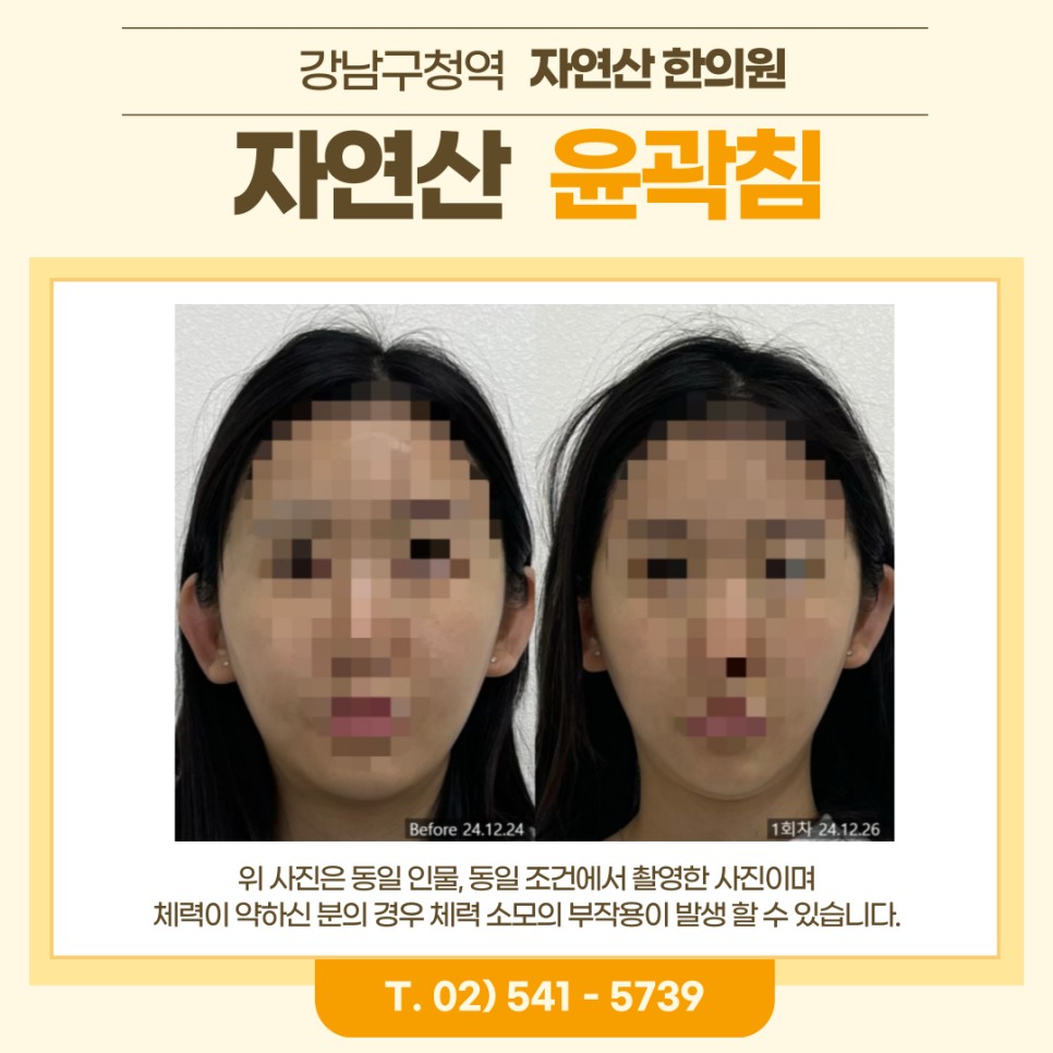 보톡스 내성 시술 기록 1 — 동일 인물·동일 조건에서 촬영한 보정 없는 원본 사진