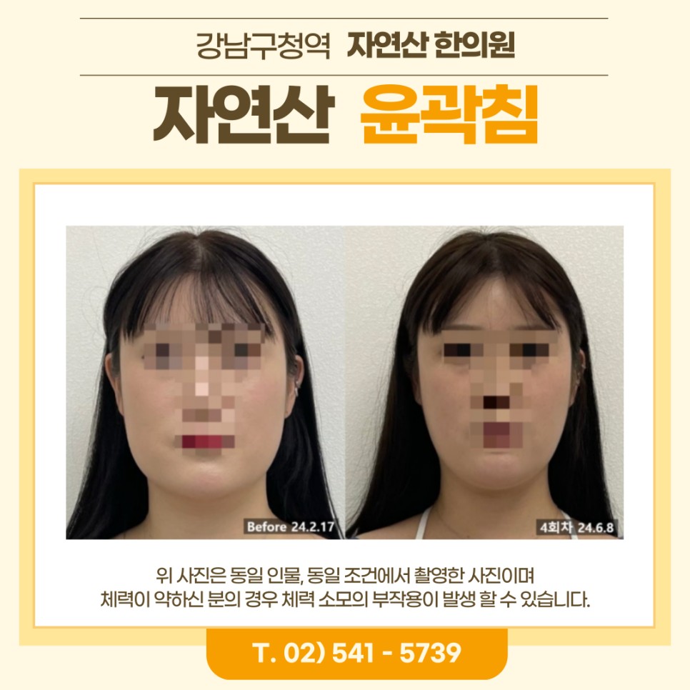 보톡스 내성 시술 기록 2 — 동일 인물·동일 조건에서 촬영한 보정 없는 원본 사진