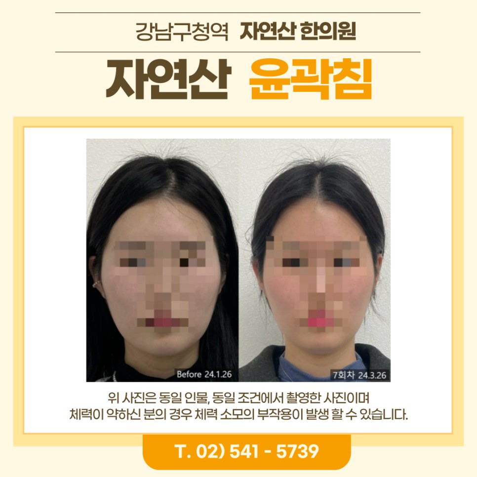 보톡스 내성 시술 기록 3 — 동일 인물·동일 조건에서 촬영한 보정 없는 원본 사진