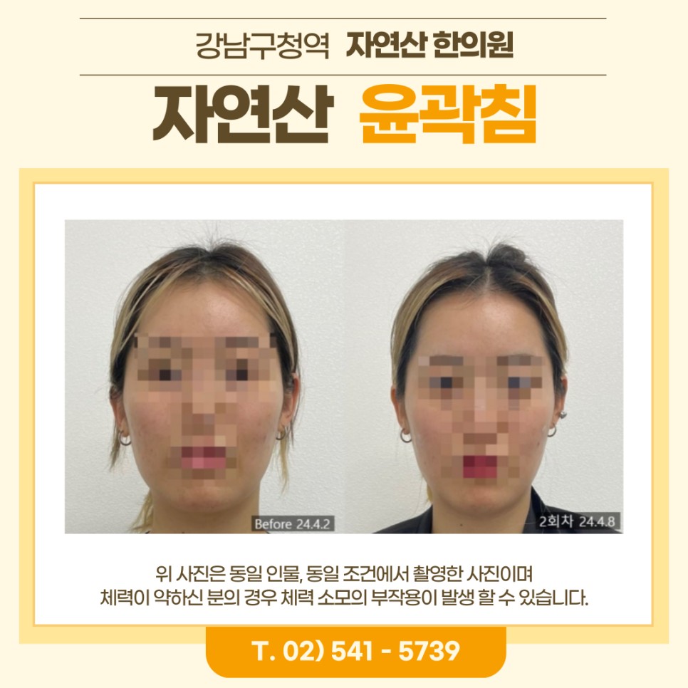 보톡스 내성 시술 기록 4 — 동일 인물·동일 조건에서 촬영한 보정 없는 원본 사진