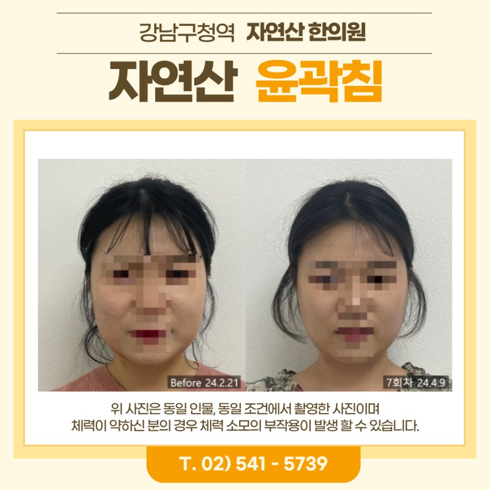 보톡스 내성 시술 기록 5 — 동일 인물·동일 조건에서 촬영한 보정 없는 원본 사진