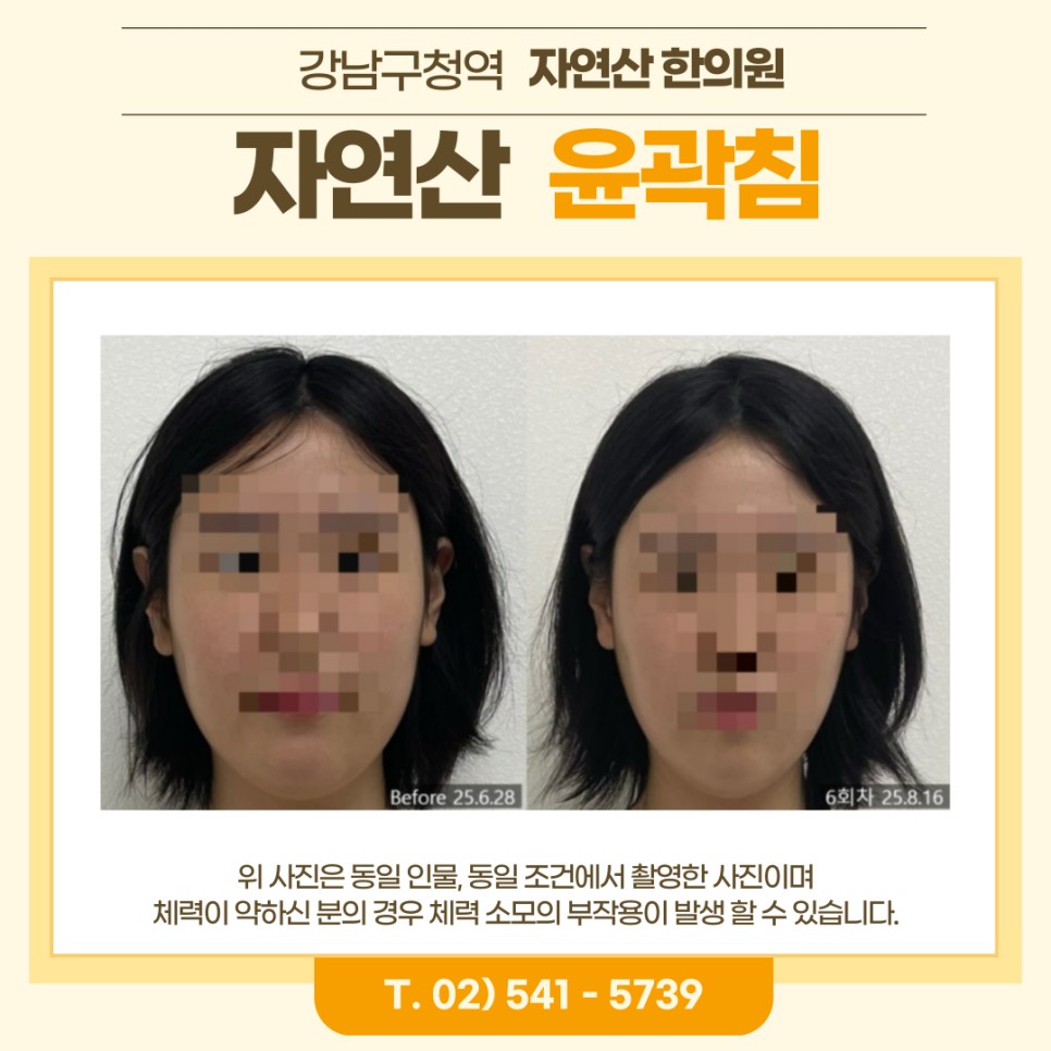 보톡스 내성 시술 기록 6 — 동일 인물·동일 조건에서 촬영한 보정 없는 원본 사진