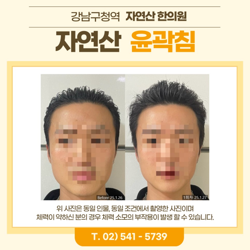 보톡스 내성 시술 기록 7 — 동일 인물·동일 조건에서 촬영한 보정 없는 원본 사진