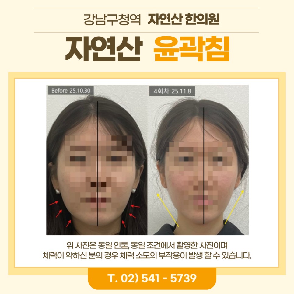 보톡스 내성 시술 기록 8 — 동일 인물·동일 조건에서 촬영한 보정 없는 원본 사진