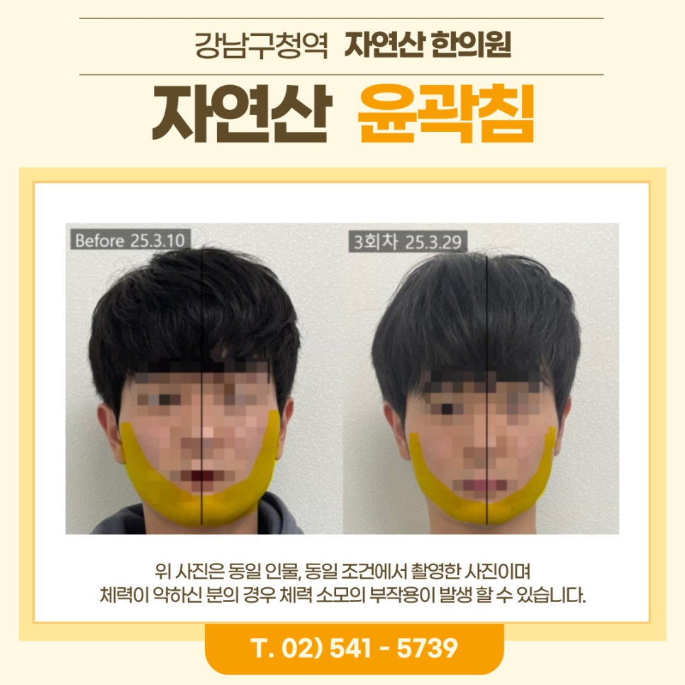 보톡스 내성 시술 기록 9 — 동일 인물·동일 조건에서 촬영한 보정 없는 원본 사진