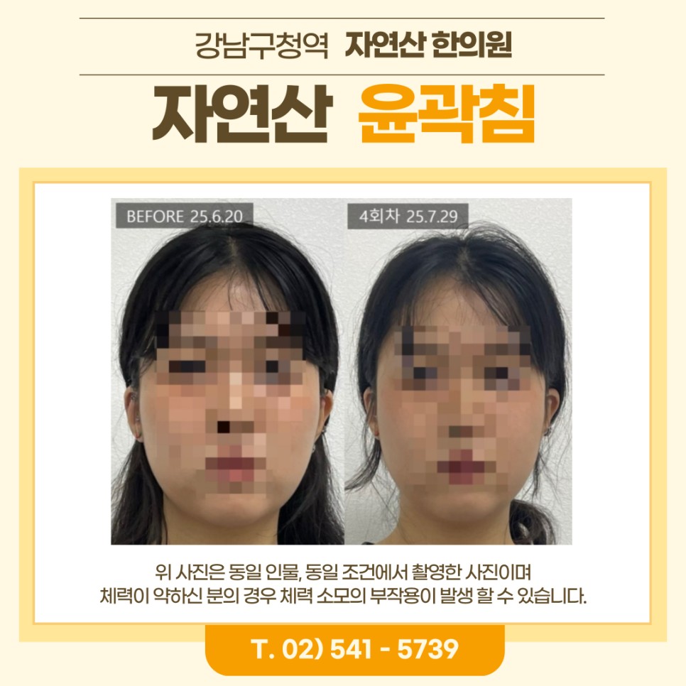 보톡스 내성 시술 기록 10 — 동일 인물·동일 조건에서 촬영한 보정 없는 원본 사진