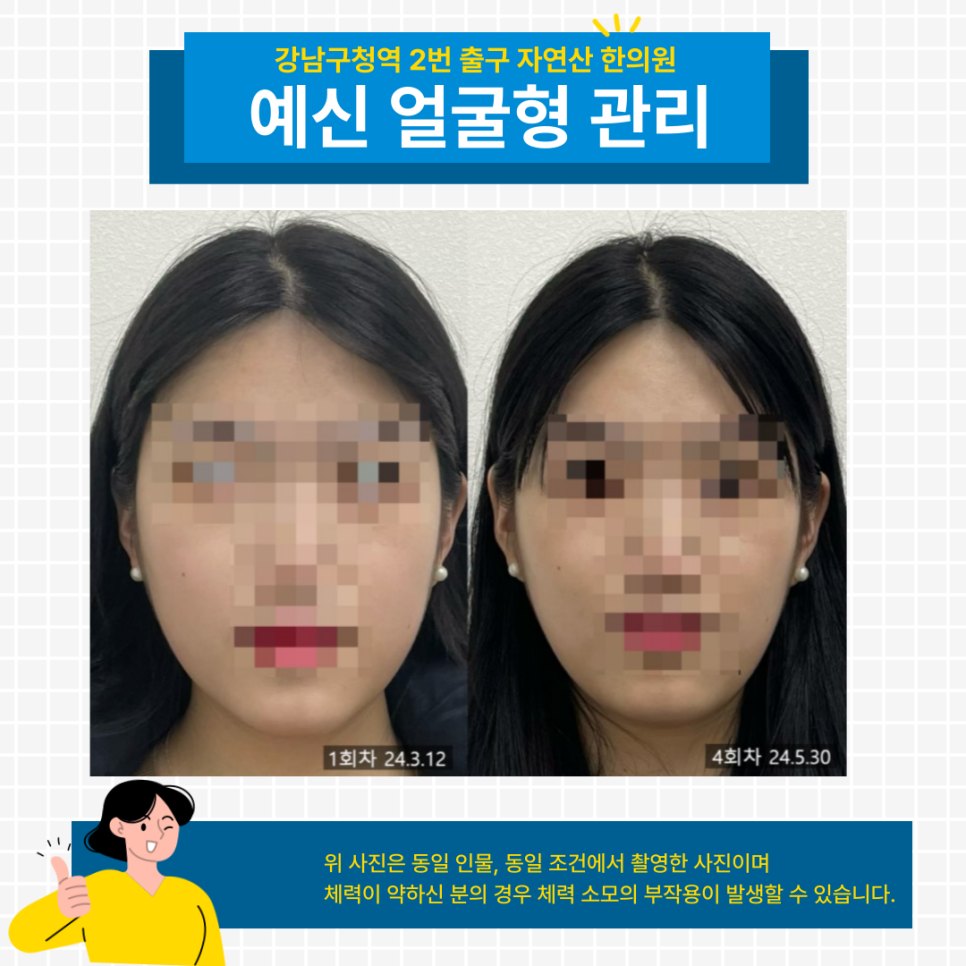 예신 얼굴형 관리 1회차와 4회차 정면 비교 — 동일 인물·동일 조건에서 촬영한 보정 없는 원본