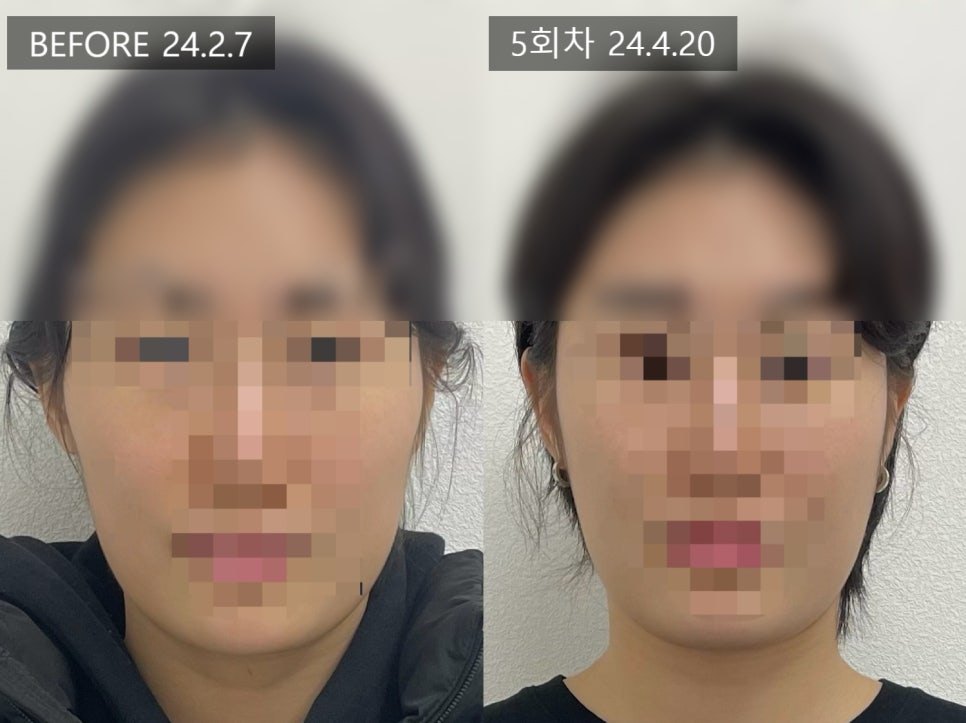 볼패임 시술 5회차 정면 전후 비교 — 동일 인물·동일 조건에서 촬영한 보정 없는 원본