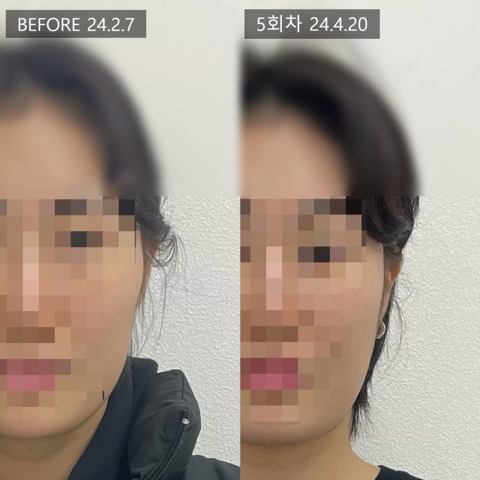 상반신까지 함께 담은 5회차 전후 비교 — 보정 없는 원본