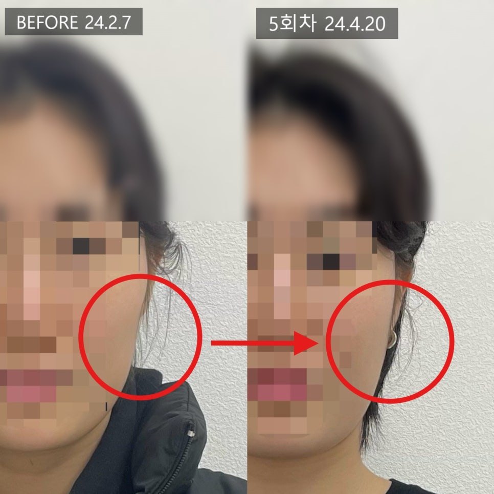 볼 구역을 원으로 감싸고 채워진 방향을 화살표로 표시한 5회차 전후 비교 — 보정 없는 원본