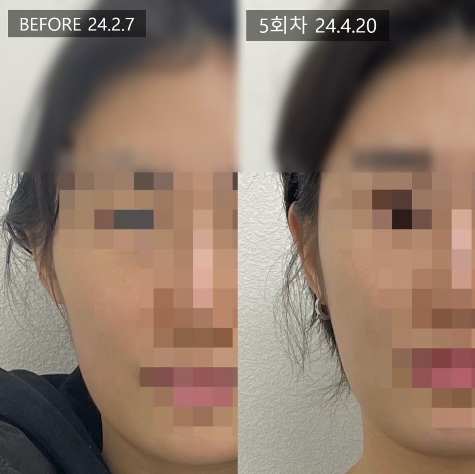 측면에서 볼 부위를 확대해 담은 5회차 전후 비교 — 보정 없는 원본