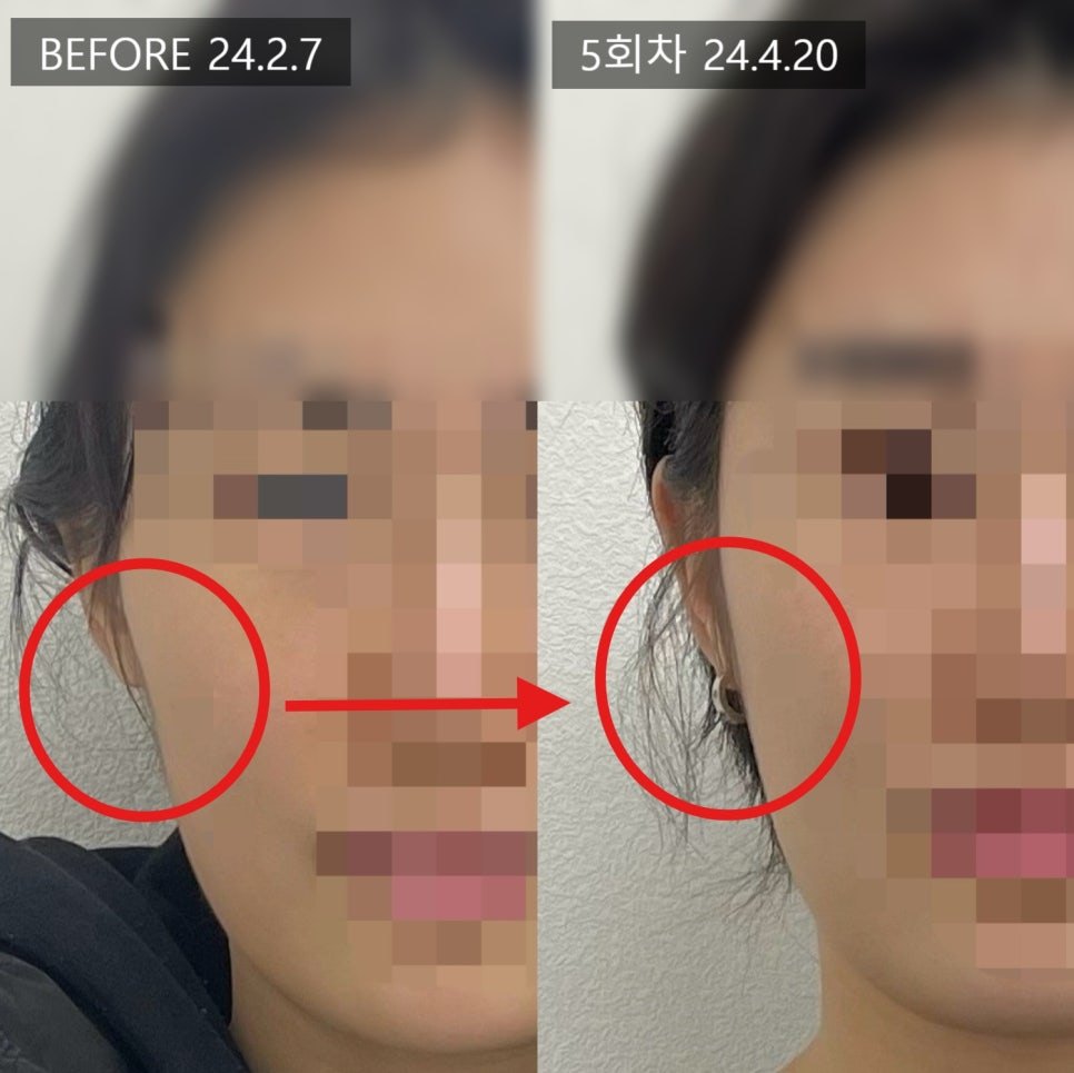 측면 사진에 원과 화살표를 얹어 옆볼의 변화를 표시한 5회차 전후 비교 — 보정 없는 원본