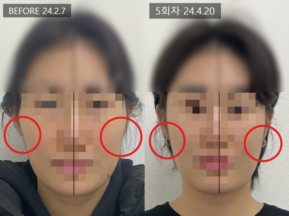 좌우 볼 네 곳을 원으로 표시해 나란히 비교한 5회차 전후 — 보정 없는 원본