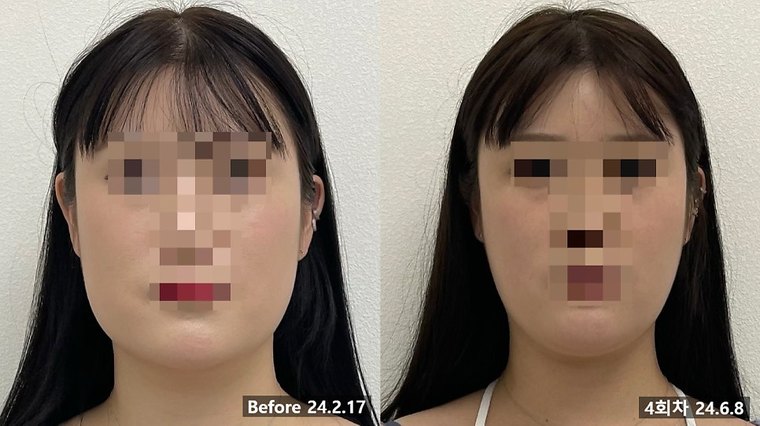 contour-korean-medicine 치료 사례 1 — 시술 전후 비교