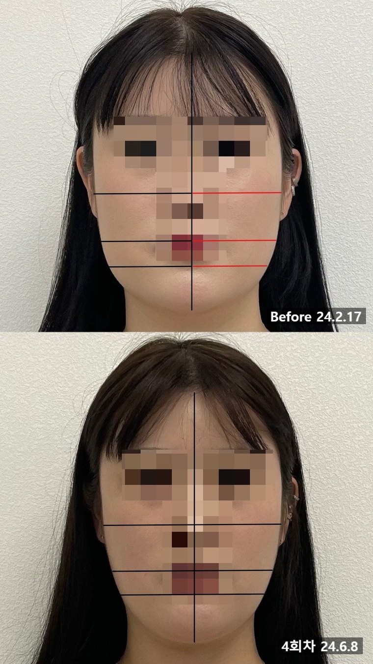 contour-korean-medicine 치료 사례 3 — 시술 전후 비교