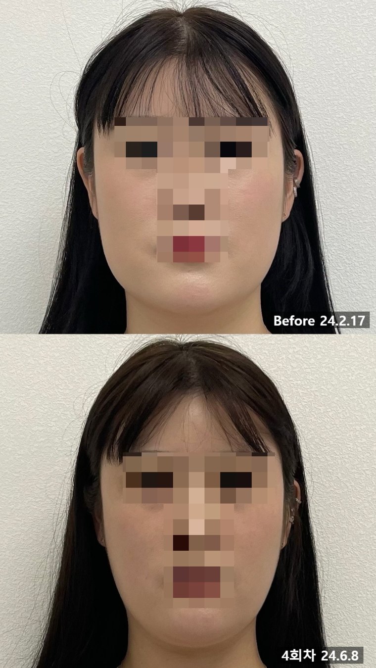 contour-korean-medicine 치료 사례 4 — 시술 전후 비교
