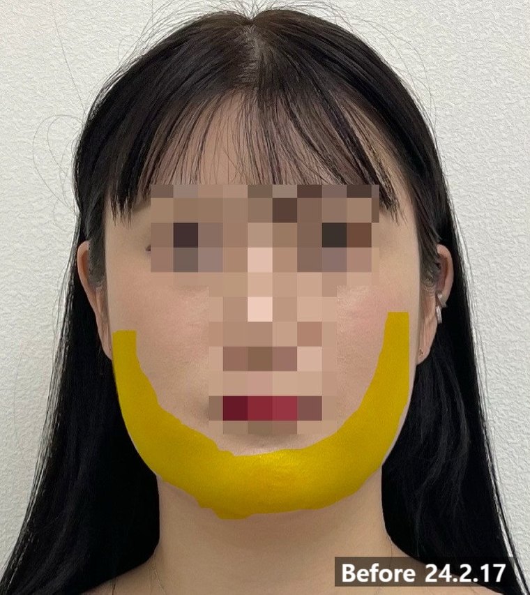 contour-korean-medicine 치료 사례 5 — 시술 전후 비교