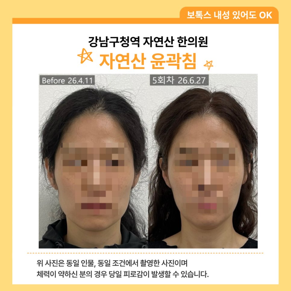 약물 없이 진행한 윤곽침 5회차 얼굴형 전후 비교 — 동일 인물·동일 조건에서 촬영한 보정 없는 원본