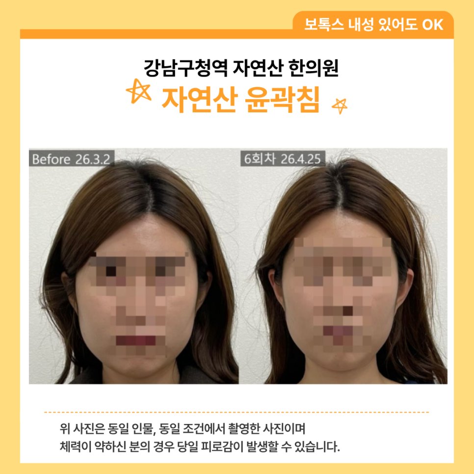 다른 분의 6회차 얼굴형 전후 비교 — 동일 인물·동일 조건에서 촬영한 보정 없는 원본