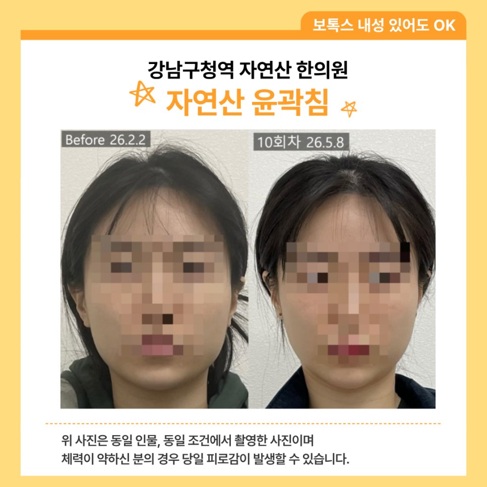 또 다른 분의 10회차 얼굴형 전후 비교 — 동일 인물·동일 조건에서 촬영한 보정 없는 원본
