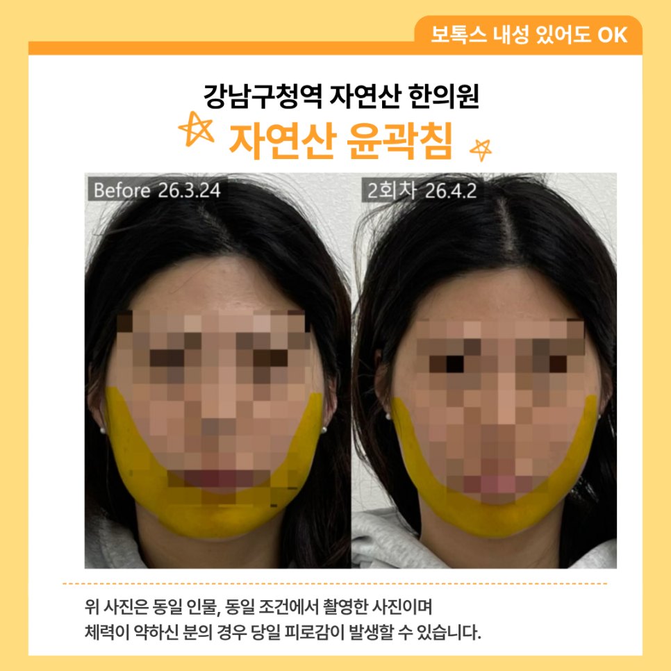 턱선 구역을 노란색으로 표시한 2회차 전후 비교 — 동일 인물·동일 조건에서 촬영한 보정 없는 원본