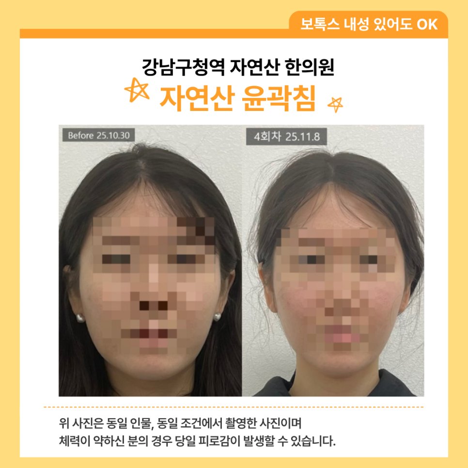 짧은 기간 4회차를 진행한 분의 얼굴형 전후 비교 — 동일 인물·동일 조건에서 촬영한 보정 없는 원본
