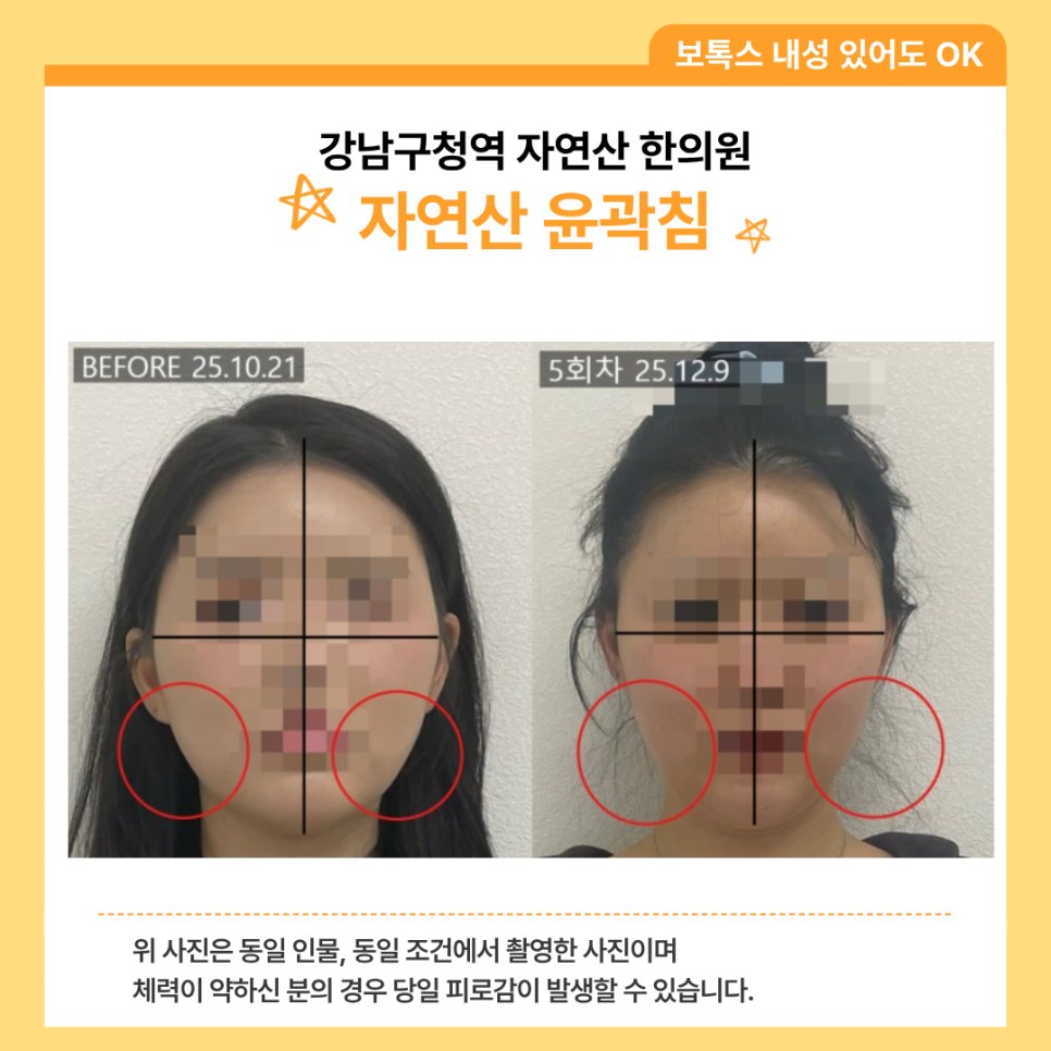 볼 구역을 원으로 표시한 5회차 전후 비교 — 동일 인물·동일 조건에서 촬영한 보정 없는 원본