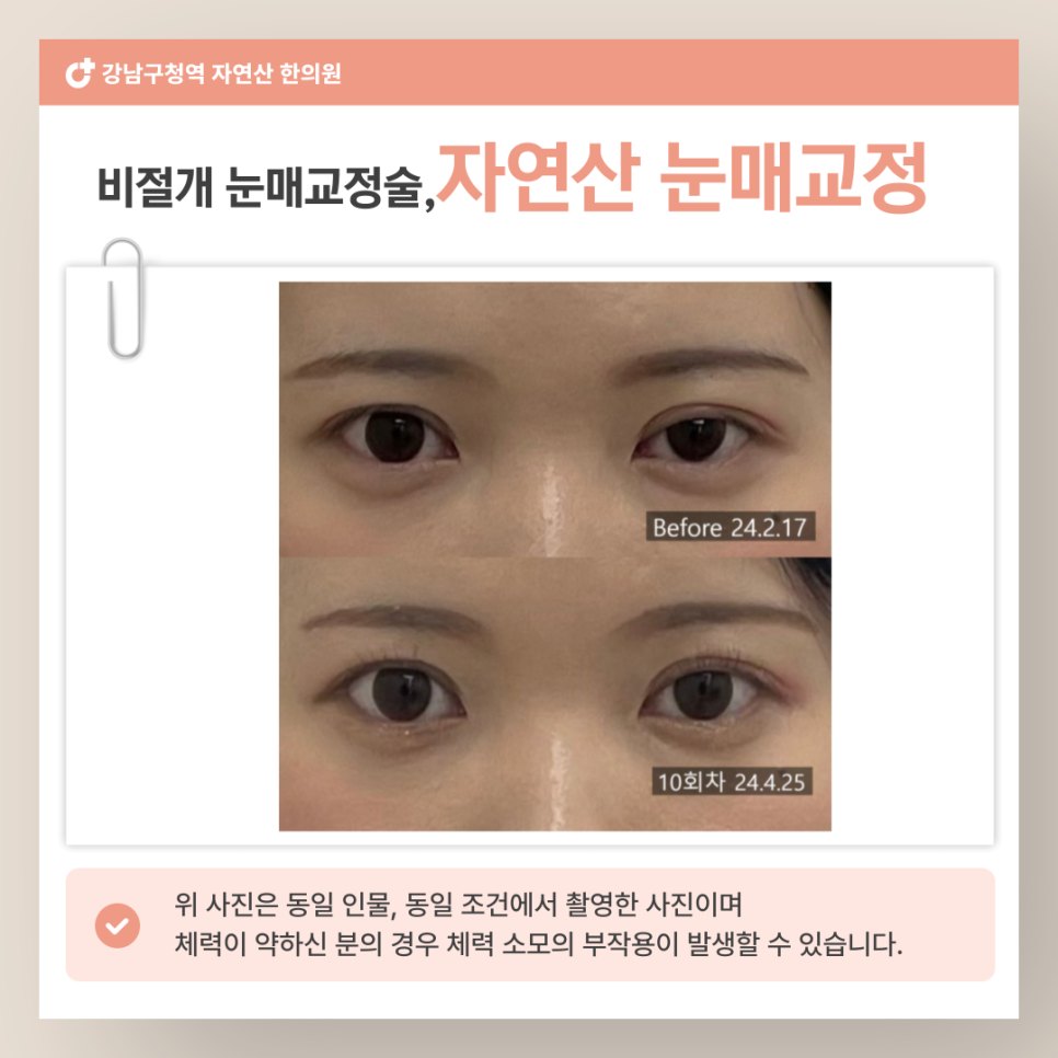 양쪽 눈을 확대해 위아래로 배치한 10회차 전후 비교 — 동일 인물·동일 조건에서 촬영한 보정 없는 원본