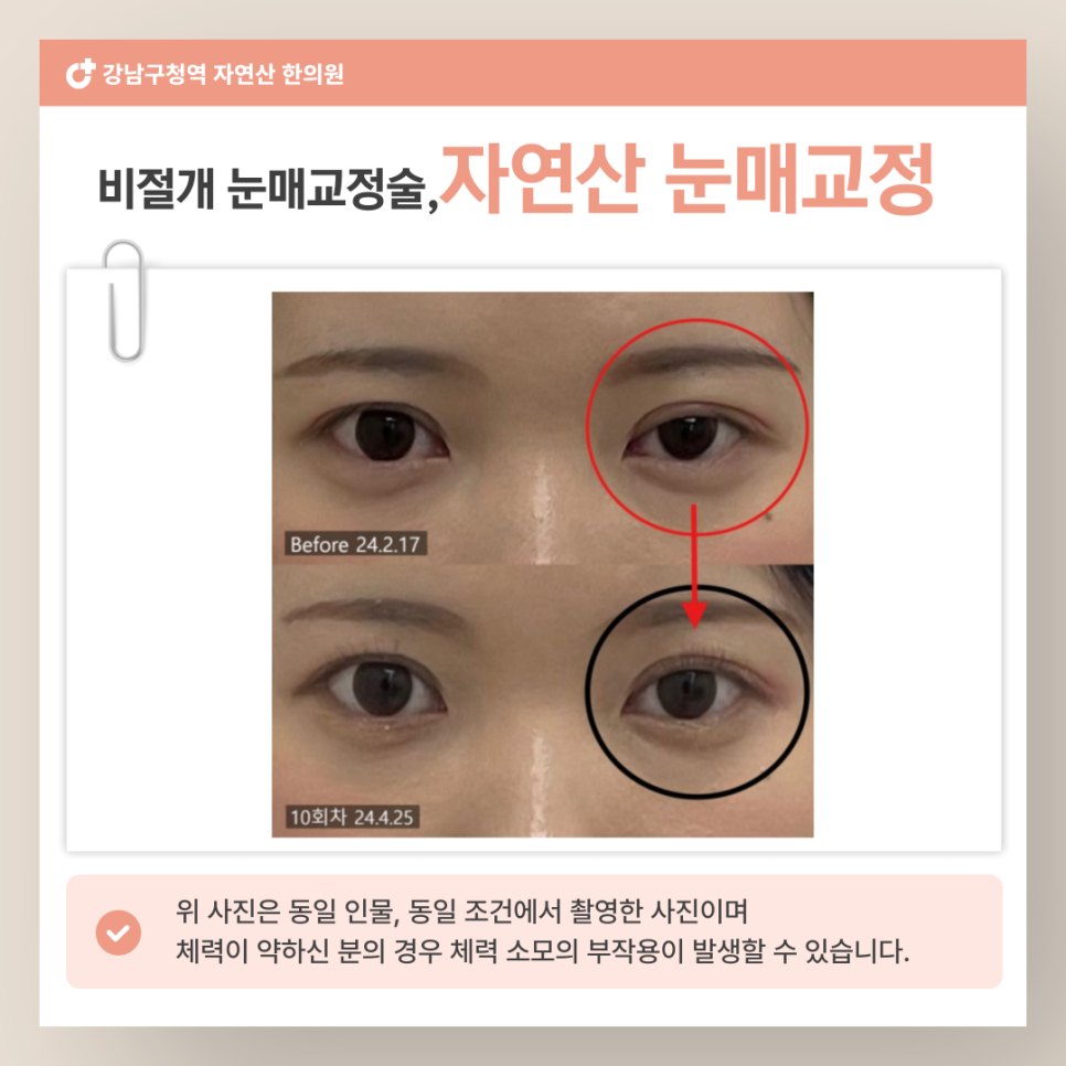 같은 10회차 전후 컷에 좌우 눈을 원으로 표시하고 화살표로 연결해 변화 방향을 나타낸 비교 — 보정 없는 원본