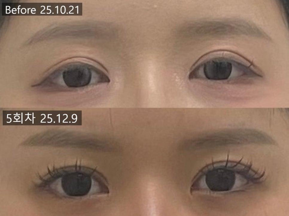 짝눈 교정 전 2025년 10월 21일과 5회차 12월 9일의 눈매 비교