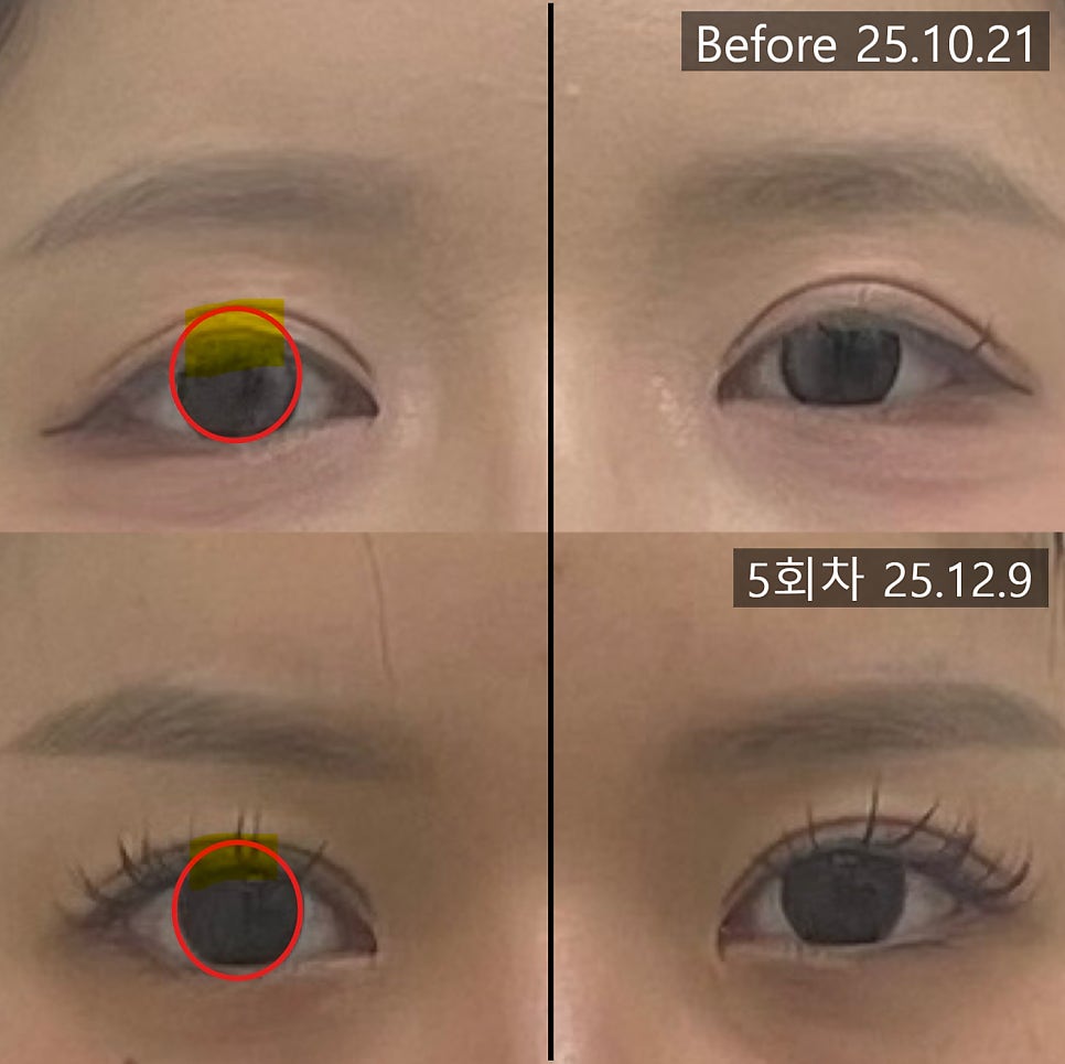 눈꺼풀이 검은동자를 덮는 정도를 표시한 짝눈 교정 전후 사진