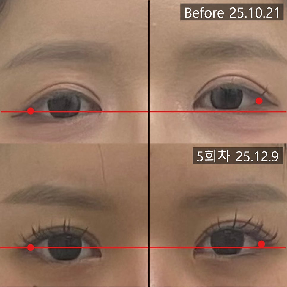 양쪽 눈꼬리 지점을 표시한 5회차 전후 비교 사진