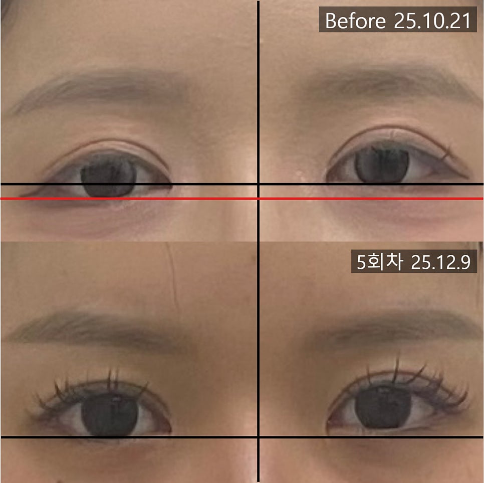 눈 아랫선의 높이 차이를 표시한 5회차 전후 비교 사진