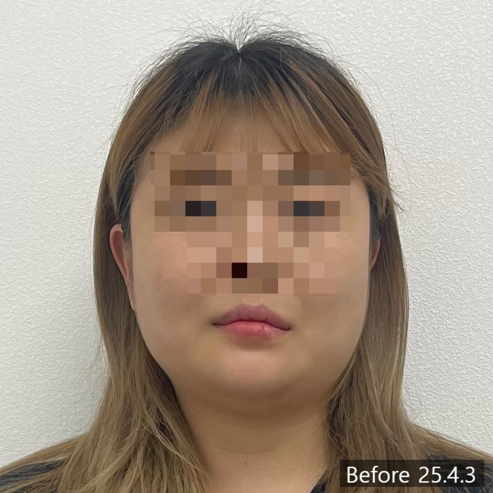 얼굴형·입꼬리 비대칭 교정 전 정면 사진 — 동일 인물·동일 조건에서 촬영한 보정 없는 원본