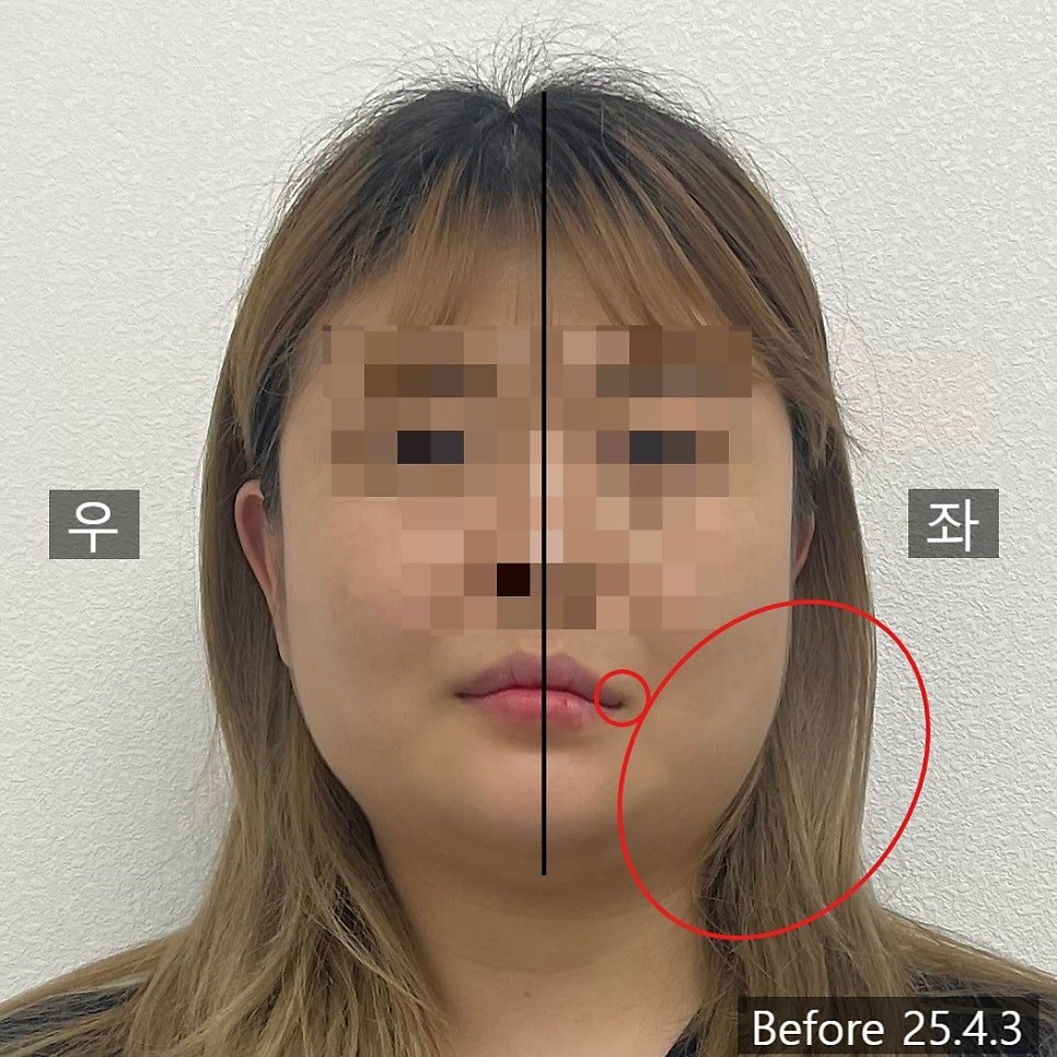 교정 전 정면에 정중선과 좌측 입꼬리 표시를 얹은 사진 — 보정 없는 원본