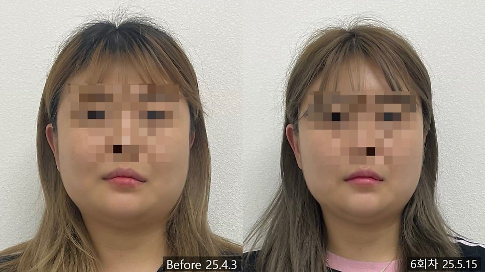 얼굴형과 입꼬리 비대칭의 교정 전과 6회차 정면 비교