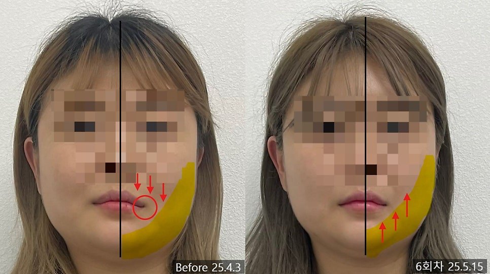 좌측 턱근육 부위에 표시한 얼굴형 비대칭 전후 비교