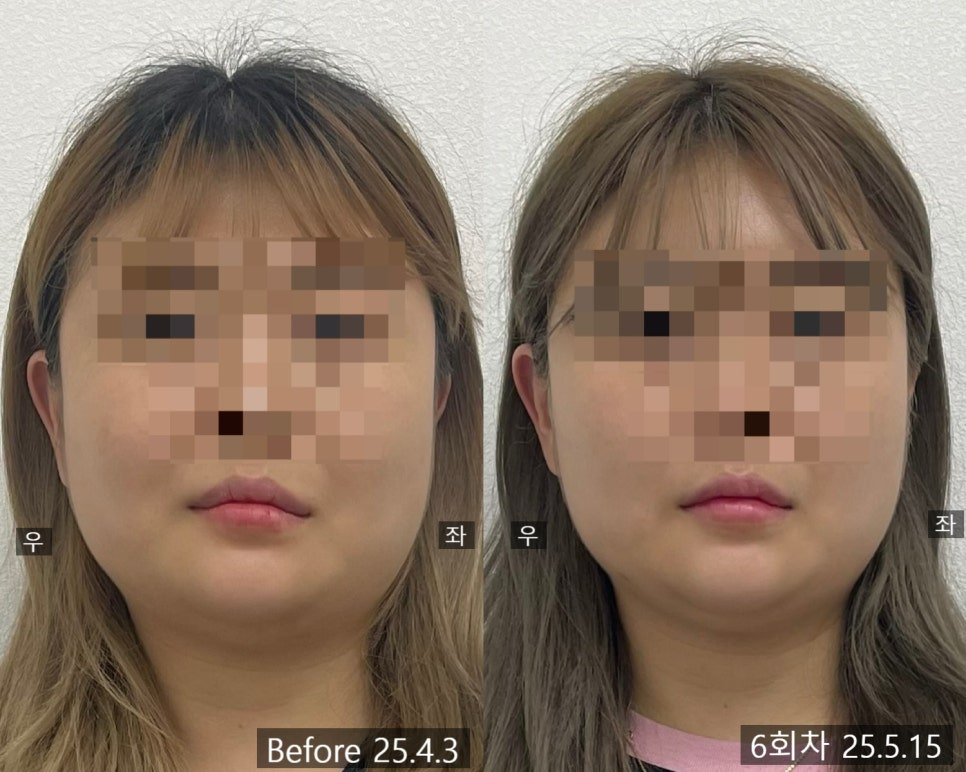 정중선 기준 좌우 폭을 비교한 전후 사진 — 보정 없는 원본