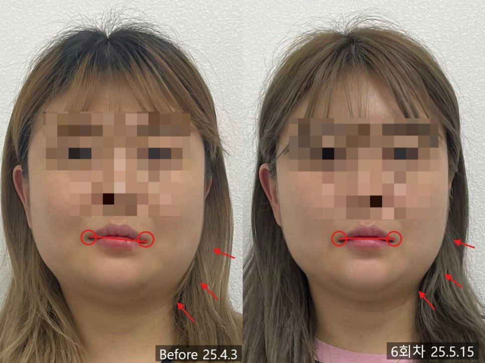 얼굴형과 함께 치료한 입꼬리 높이 차이의 전후 비교