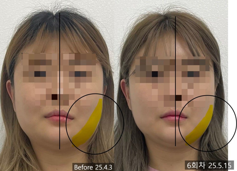좌측 저작근 영역을 표시한 전후 비교 — 보정 없는 원본