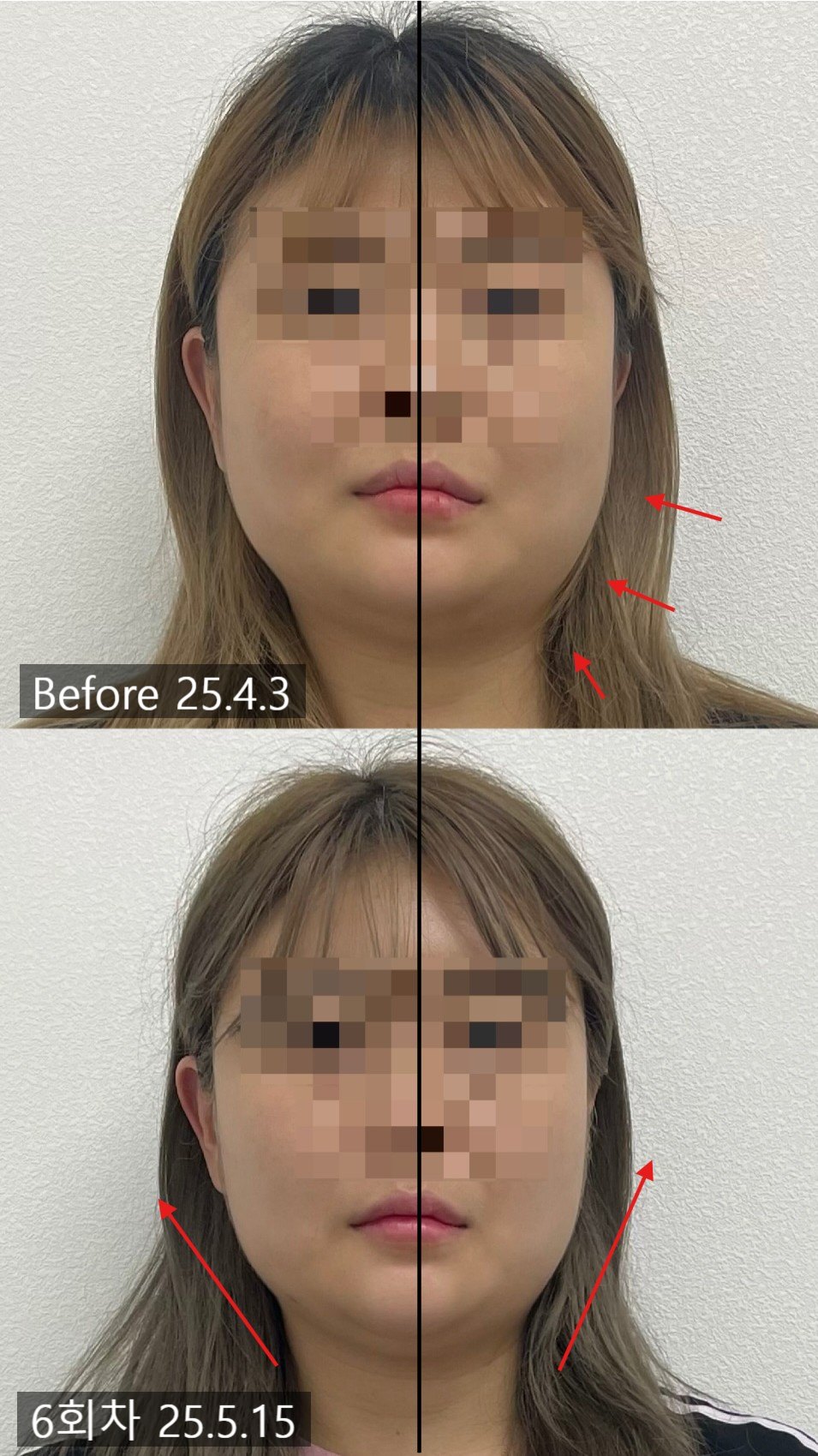 정중선을 기준으로 턱선 좌우 차이를 표시한 전후 비교 — 보정 없는 원본