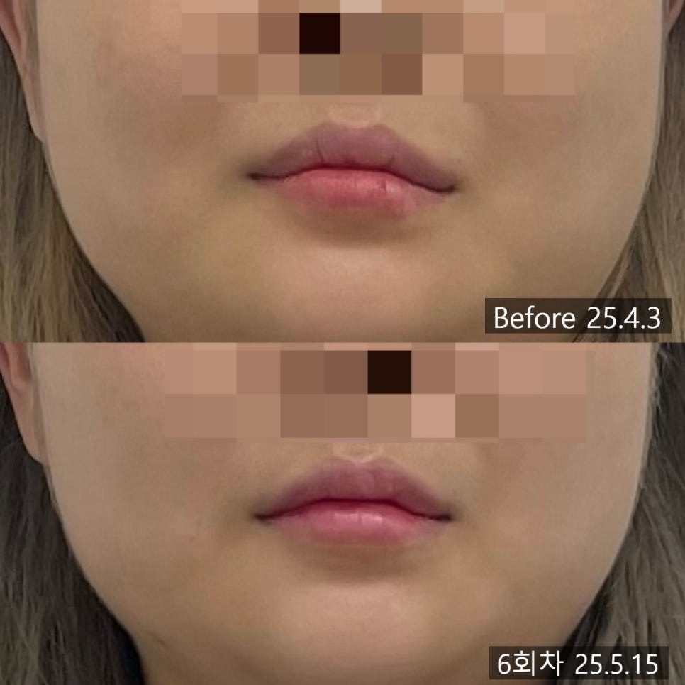 입 주위를 확대한 교정 전후 비교 — 보정 없는 원본