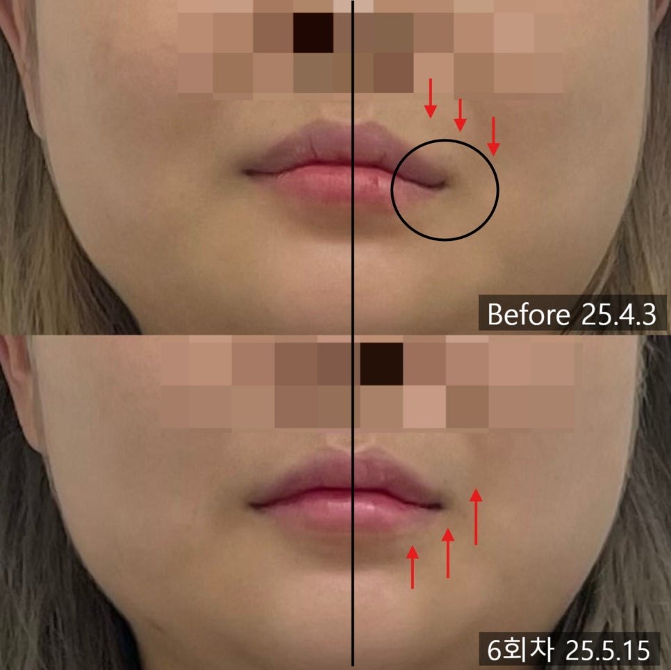 좌측 입꼬리 하강과 회복 방향을 화살표로 표시한 확대 비교 — 보정 없는 원본