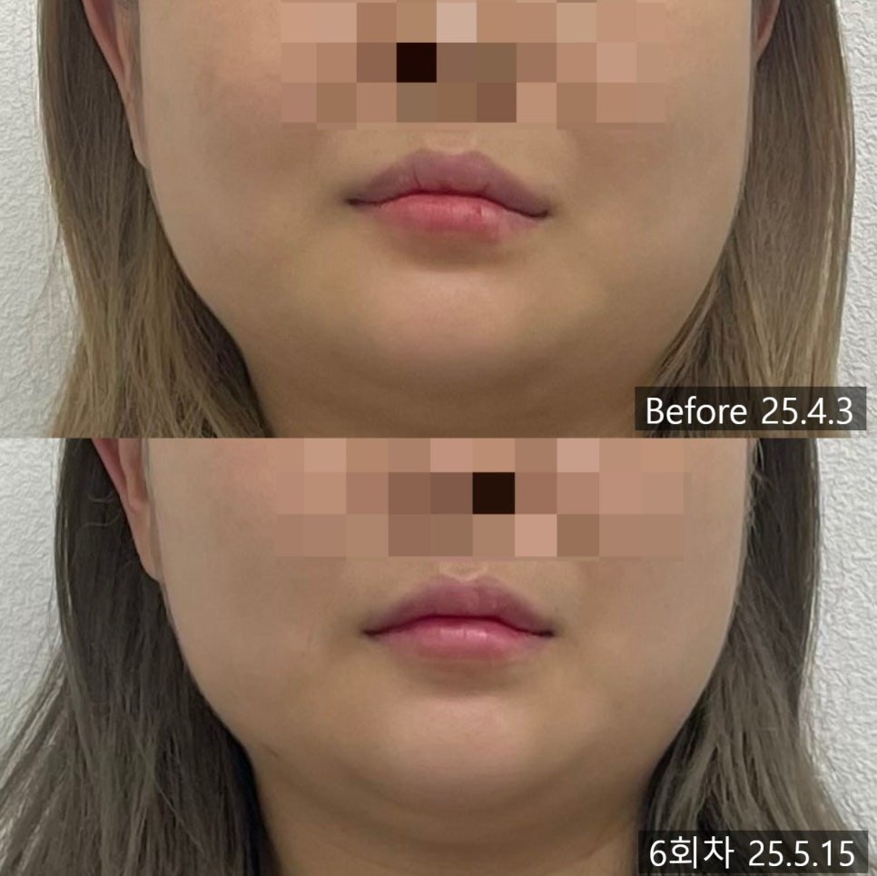 표시 없이 입 주위만 확대한 교정 전후 비교 — 보정 없는 원본